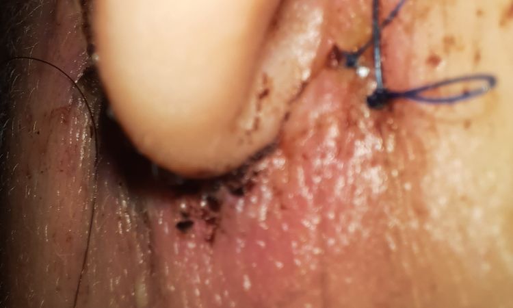 Probleme nach einem Facelifting - 47986