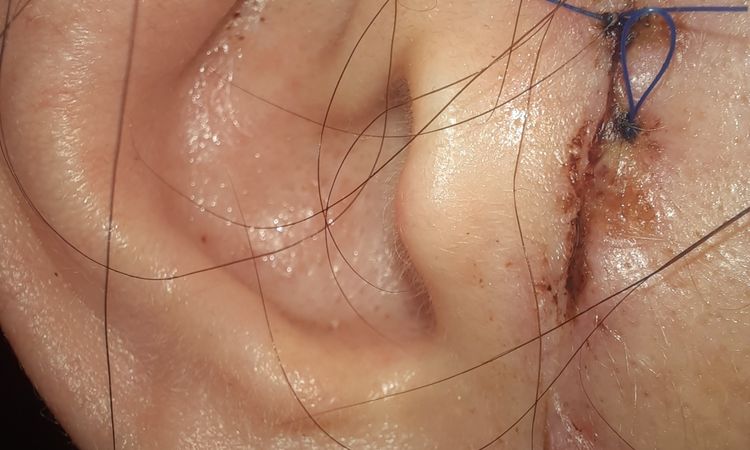 Probleme nach einem Facelifting - 47987
