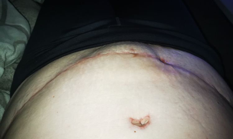 Verhärtung nach Liposuktion Bauch - 47988