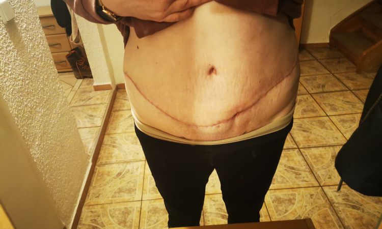 Verhärtung nach Liposuktion Bauch - 47989