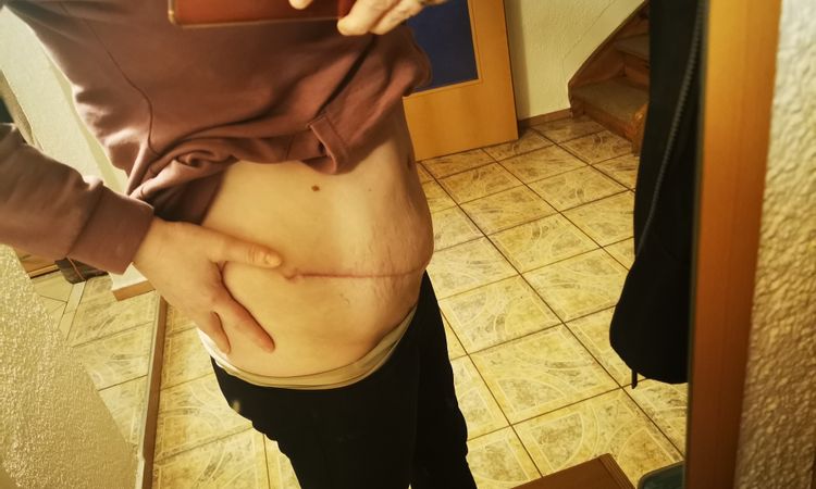 Verhärtung nach Liposuktion Bauch - 47990