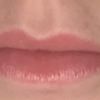 Lippe asymmetrisch Lippe hängt