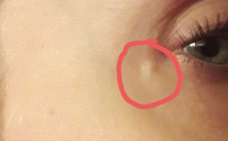 Löst Sich Ein Fadengranulom Auf www.estheticon.de