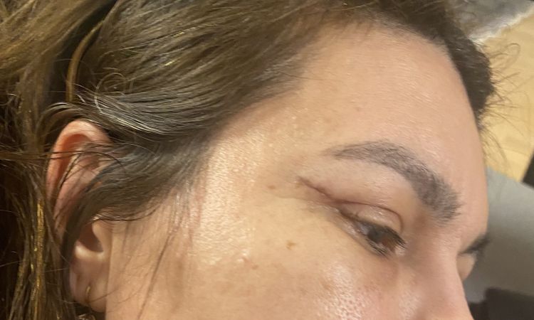 Nach 1 Monat Blepharoplastik  starke Narben - 48082