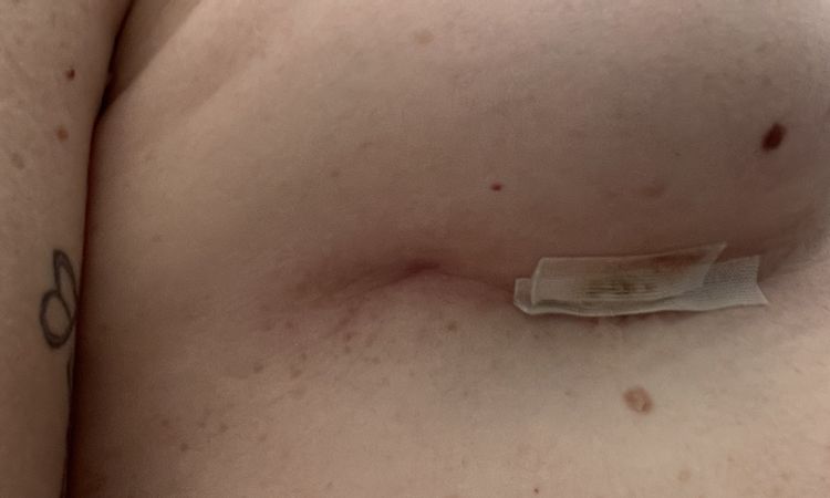 Kapselfibrose 8 Wochen Post Op? - 48183
