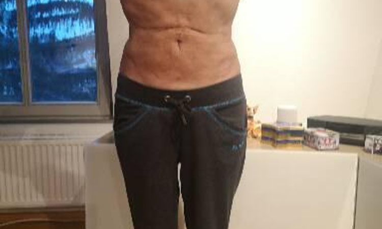 Schmerzhafte Einziehung oberhalb des Bauchnabels nach Lipo - 48192