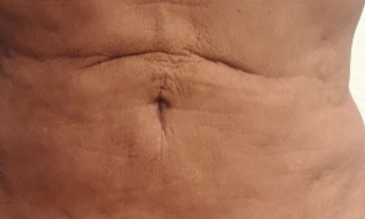 Schmerzhafte Einziehung oberhalb des Bauchnabels nach Lipo - 48193