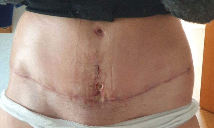 Wundheilungsstörung Bauchdeckenstraffung - 48245
