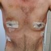 Gynäkomastie - Mastektomie Liposuction -  asymmetrisches Ergebnis