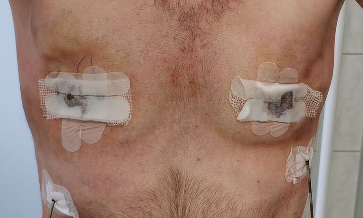 Gynäkomastie - Mastektomie Liposuction - asymmetrisches Ergebnis - 48264