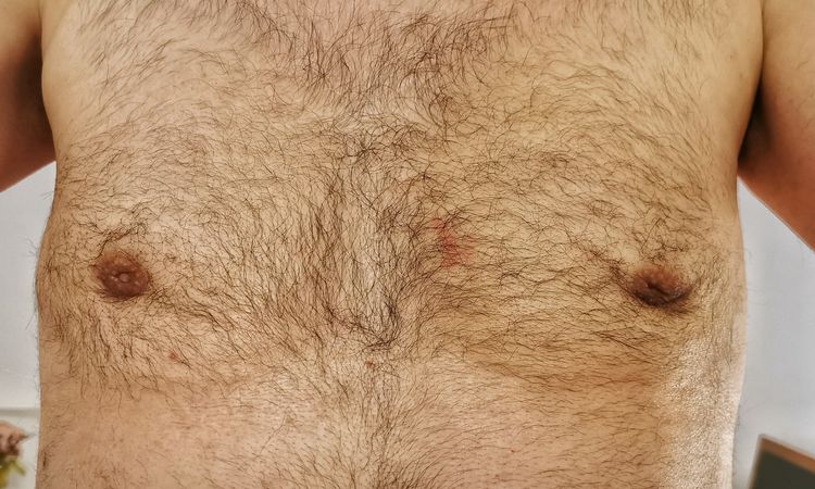 Gynäkomastie - Mastektomie Liposuction - asymmetrisches Ergebnis - 48265