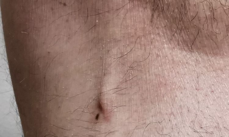 Gynäkomastie - Mastektomie Liposuction - asymmetrisches Ergebnis - 48268