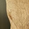 Gynäkomastie - Mastektomie Liposuction -  asymmetrisches Ergebnis - 48269
