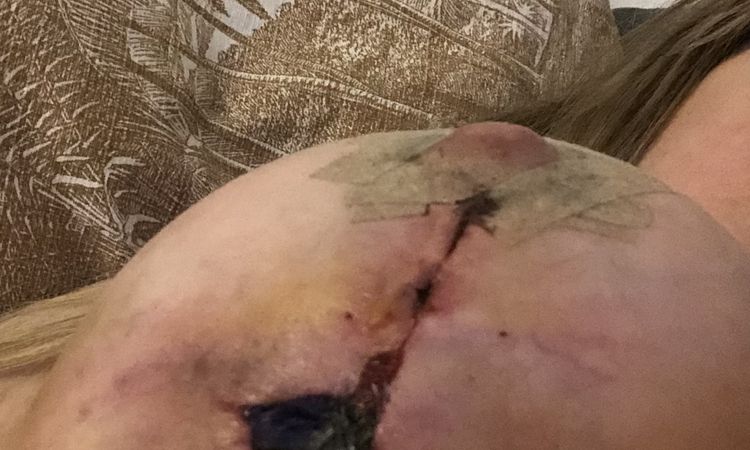 Wundheilungsstörung nach Bruststraffung mit Implantat? - 48392