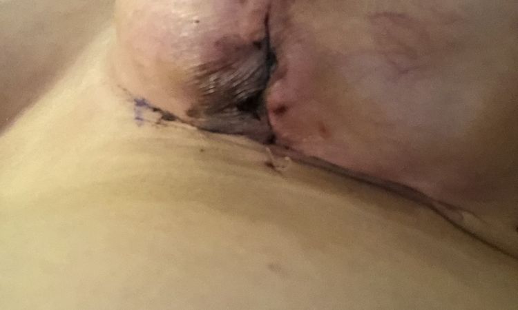 Wundheilungsstörung nach Bruststraffung mit Implantat? - 48393
