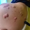 Brust Op und Keliode