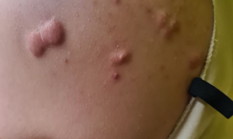 Brust Op und Keliode - 48421