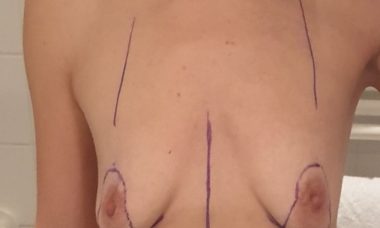 Bruststraffung mit Eigenfetttransfer: unglücklich mit Ergebnis - 48571