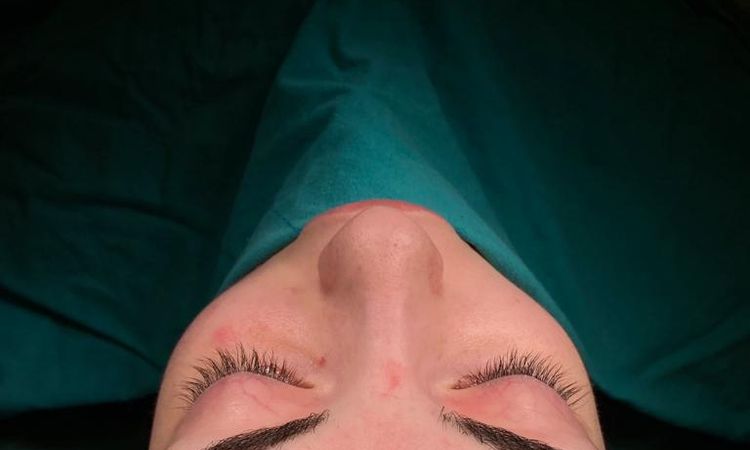 Nach Rhinoplastik Frontprofil schrecklich! - 48640