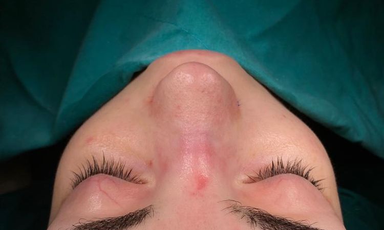 Nach Rhinoplastik Frontprofil schrecklich! - 48641