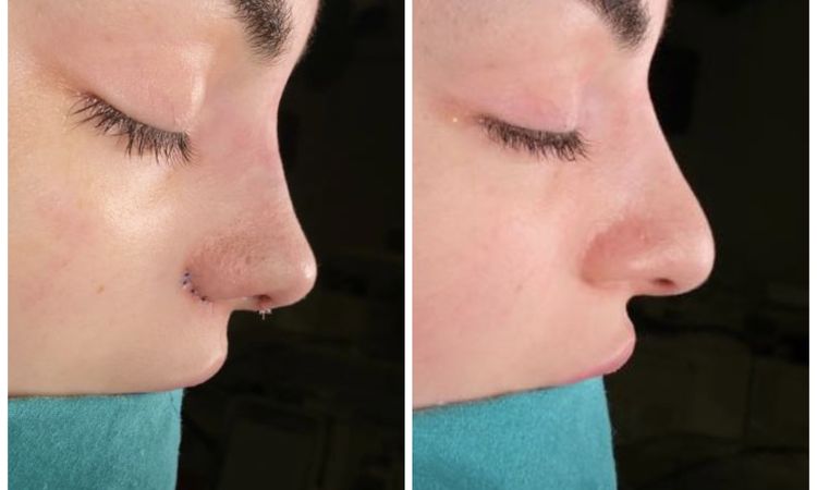 Nach Rhinoplastik Frontprofil schrecklich! - 48642