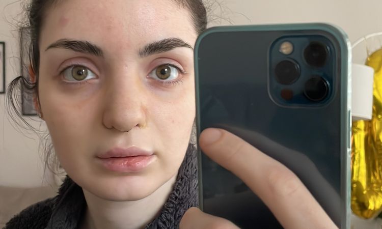 Nach Rhinoplastik Frontprofil schrecklich! - 48643