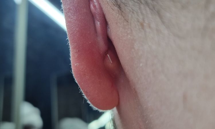 hypertophe Narbe / Keloid , oder normale Narbenschweklubg nach Ohren OP? - 48695