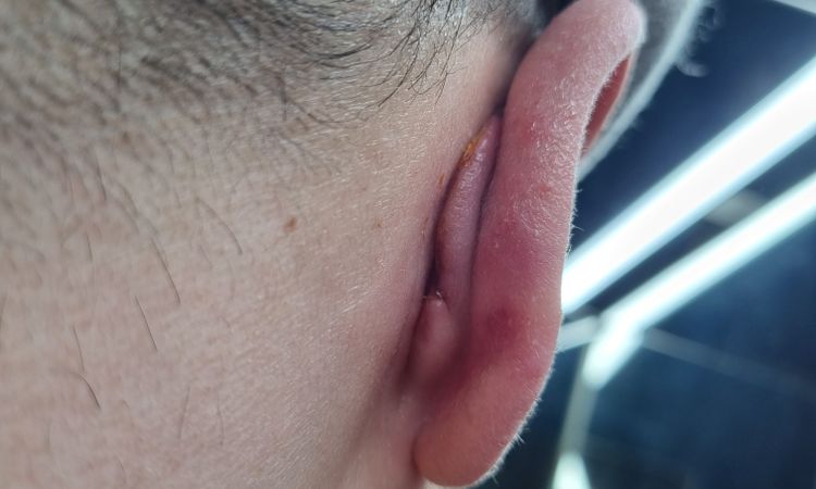 hypertophe Narbe / Keloid , oder normale Narbenschweklubg nach Ohren OP? - 48696