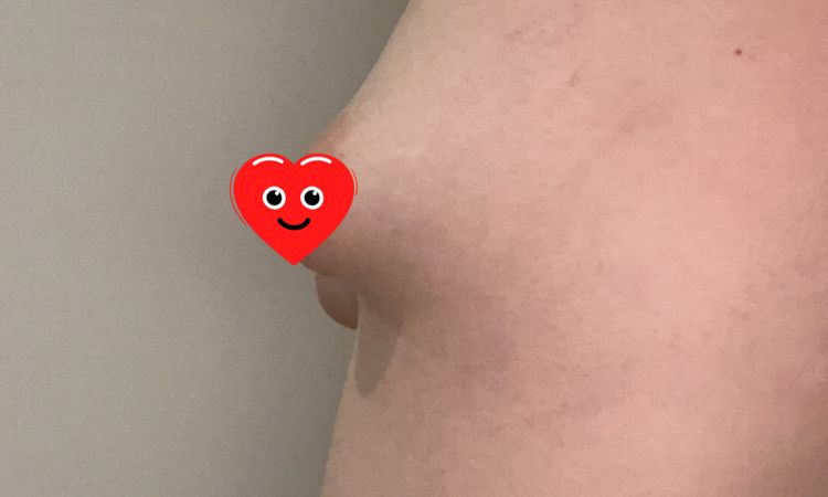 Wie viel cc bei Motiva Ergonomix tubuläre Brust? - 48698