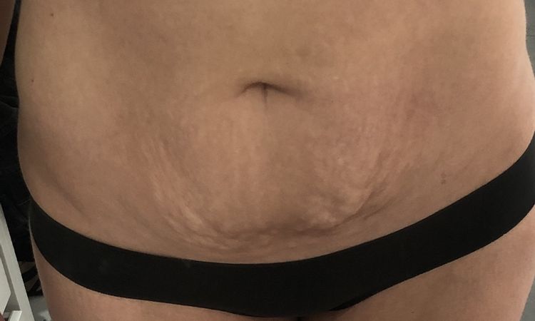 12 Wochen nach Mini Bauchstraffung und Lipo, wird es noch besser? - 48946