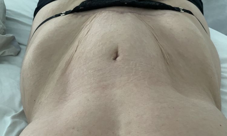12 Wochen nach Mini Bauchstraffung und Lipo, wird es noch besser? - 48947