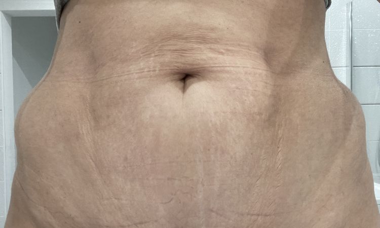 12 Wochen nach Mini Bauchstraffung und Lipo, wird es noch besser? - 48948