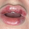 Was hilft gegen Schwellung und blaue Flecken nach Lippenunterspritzung?