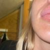 Schwellung an den Mundwinkeln nach Lippenunterspritzung