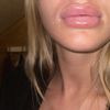 Schwellung an den Mundwinkeln nach Lippenunterspritzung