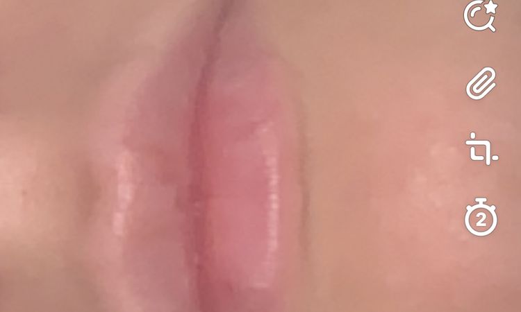 Lippen abgeschwollen jedoch nicht gleichmäßig - 49256