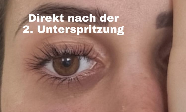 Augenringunterspritzung - 49278