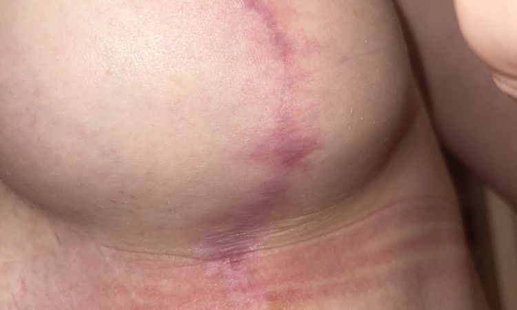 Fremdkörper Gefühl 4 Monate nach bruststraffung - 49295