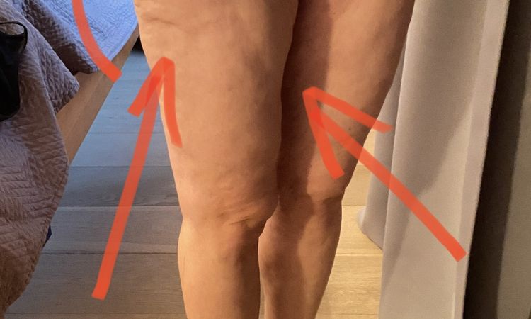 Dellen und Unebenheiten nach einer Liposuktion - 49508
