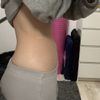 Unebener Bauch nach liposuction