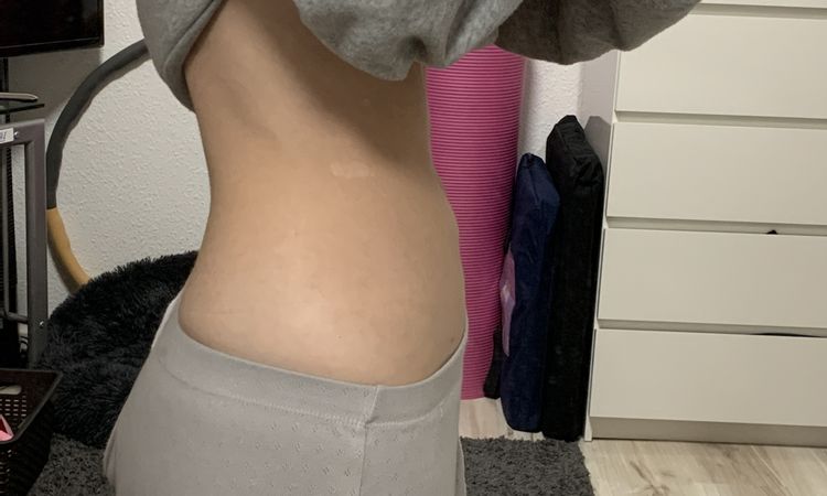 Unebener Bauch nach liposuction - 49523