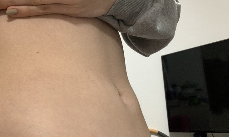 Unebener Bauch nach liposuction - 49524
