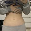 Unebener Bauch nach liposuction