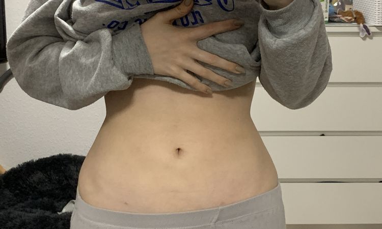 Unebener Bauch nach liposuction - 49525