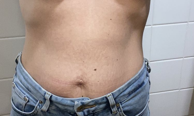 Tubuläre Brust Grad? - 49544
