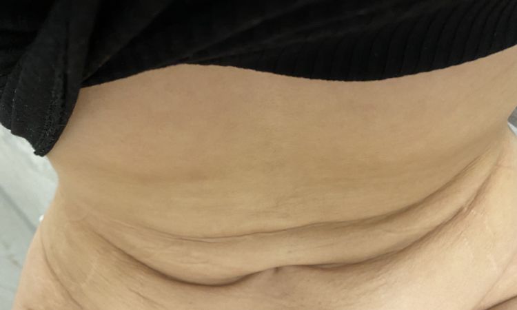 Bauch straffen mit Laser - 49557