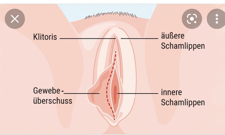 Schamlippenverkleinerung - 49606