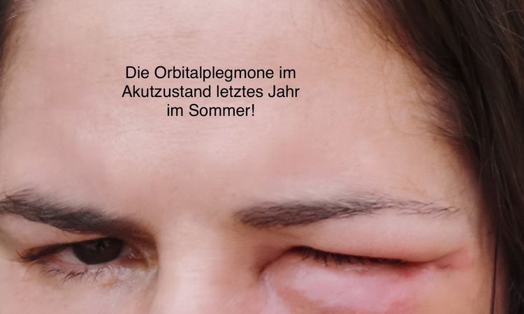 Femdkörpergranulom nach Orbitalplegmone? Immer noch keine Lösung 😥 - 49789