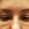Schwellung unter den Auge 2 Jahre nach Hyaluron gegen Augenringe