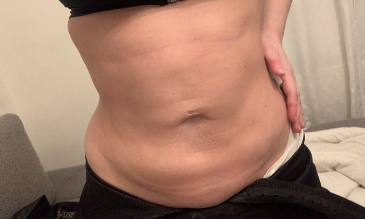 20 Tage nach fettabsaugung - 49986